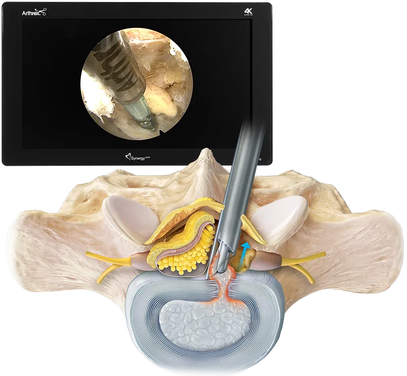 Endoscopic Discectomy