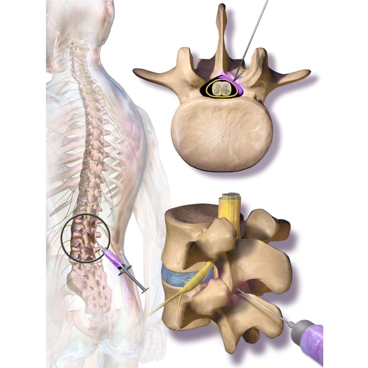 Epidural Steroid Injections
