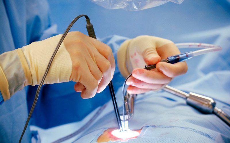 Laser Piles Surgery