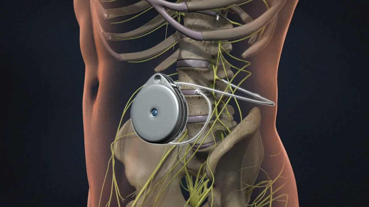 Neuromodulation And Intrathecal Pumps