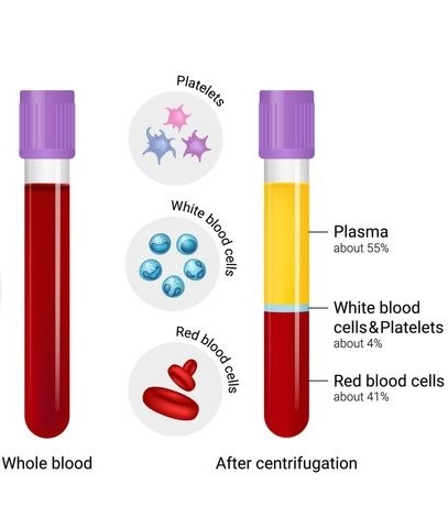Platelet Rich Plasma