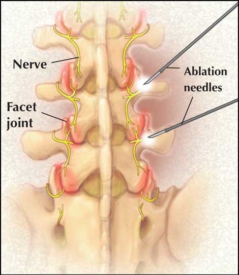 Radiofrequency Ablation