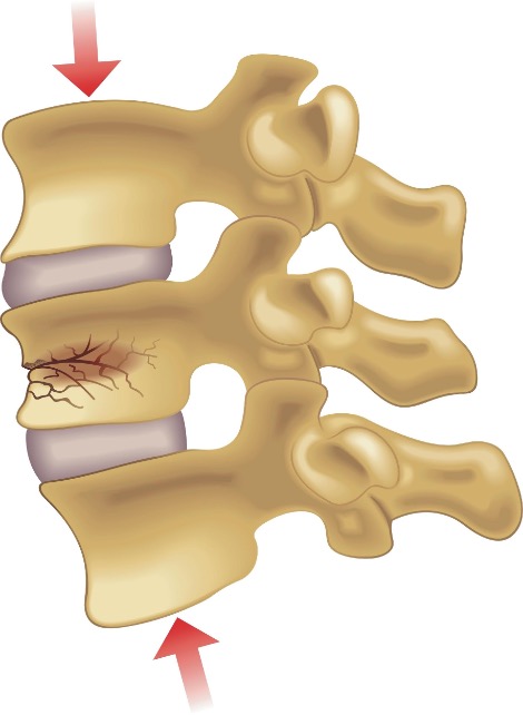 Vertebroplasty